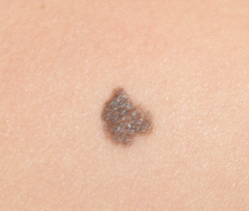 This is an example of a basal cell carcinoma.