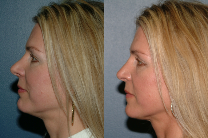 This is an example of a basal cell carcinoma.