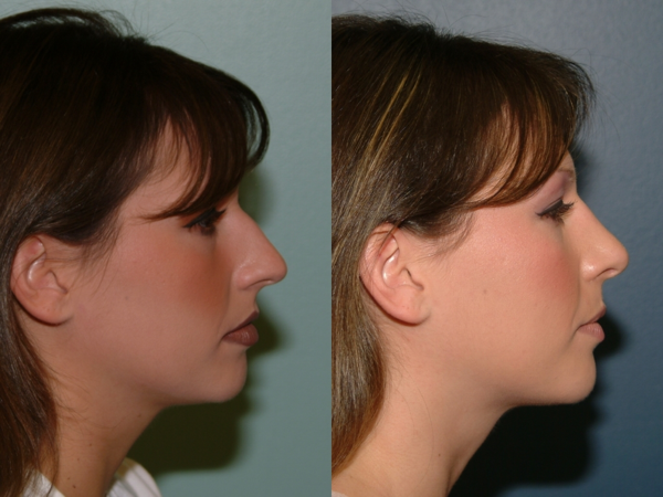 This is an example of a basal cell carcinoma.