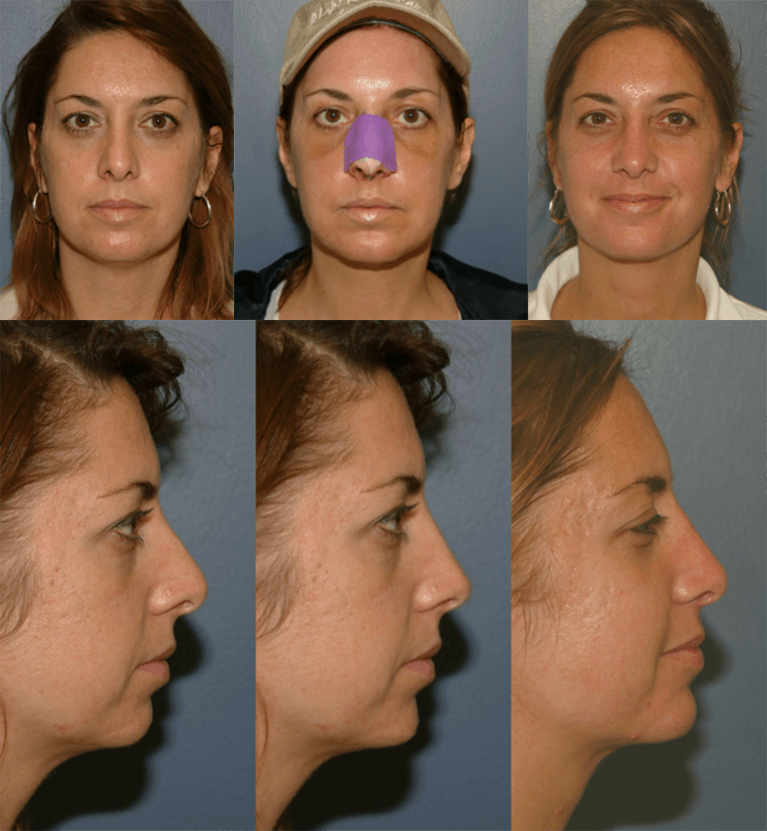 This is an example of a basal cell carcinoma.