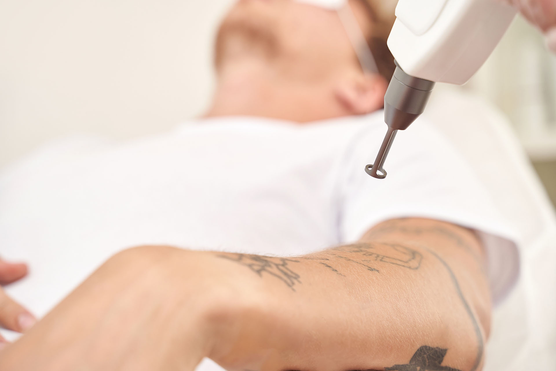 Laser tattoo removal treatment on a patient's forearm