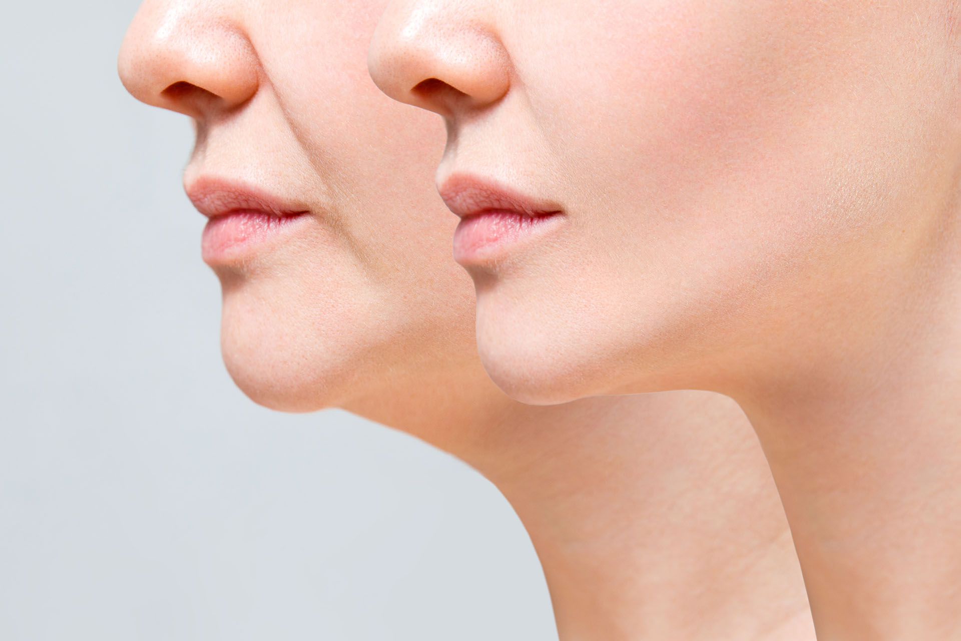 Before and after comparison of a woman's jawline and neck profile