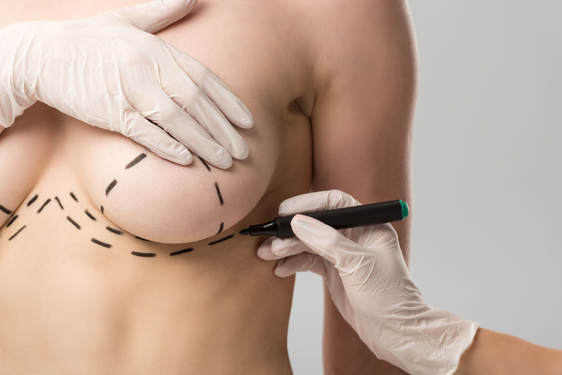 Surgeon marking surgical guidelines on a patient's breast before a breast lift