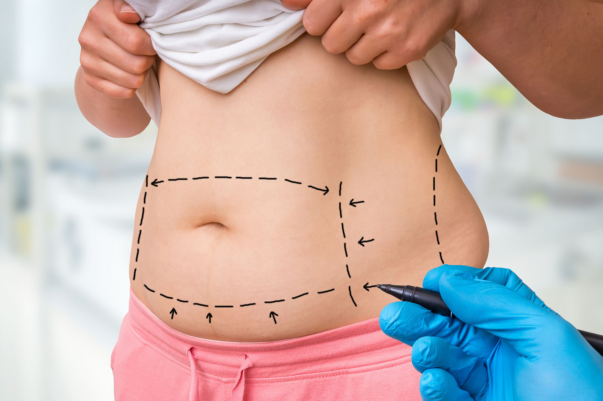 Plastic surgeon drawing marker lines on a patient's abdomen before liposuction