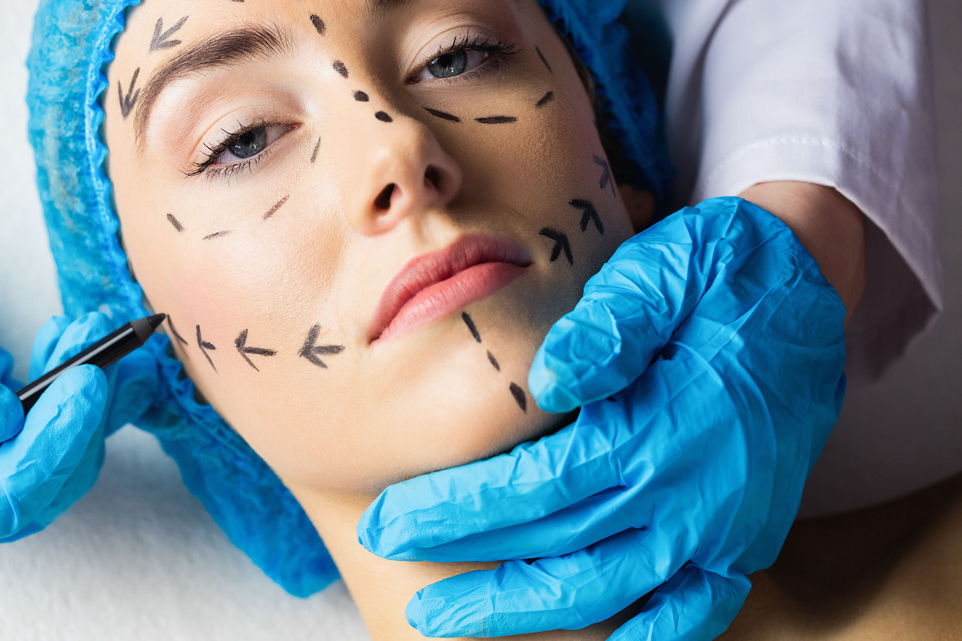 Patient with dotted surgical planning lines marked on her face