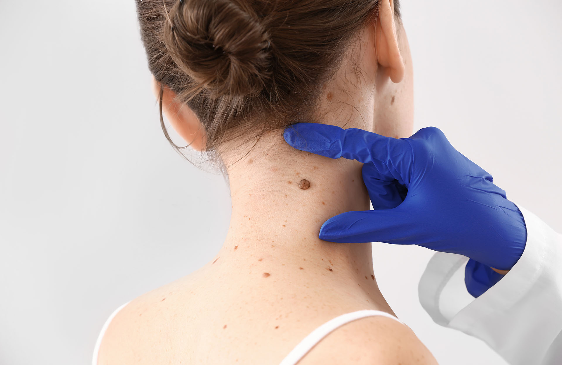 Dermatologist examining moles on a patient's skin