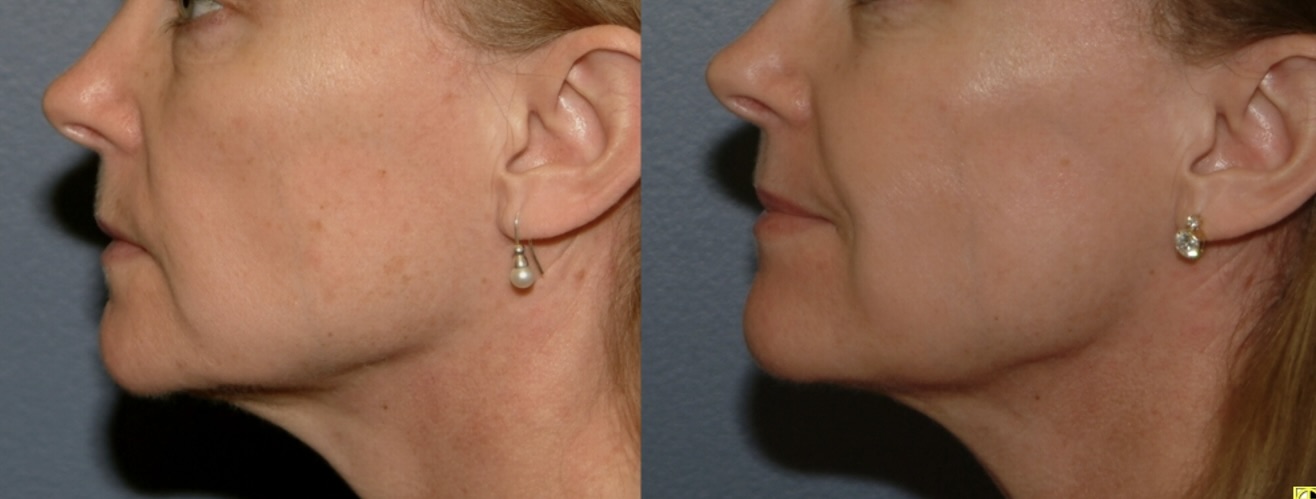 Close-up profile of a woman's face and ear after a chemical peel