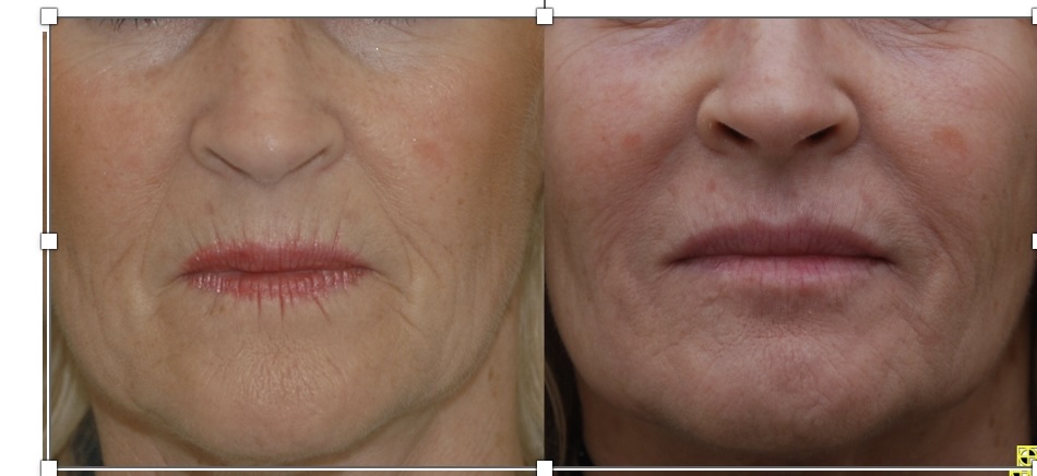 Close-up of a woman's cheek and eye area showing fine lines before filler treatment