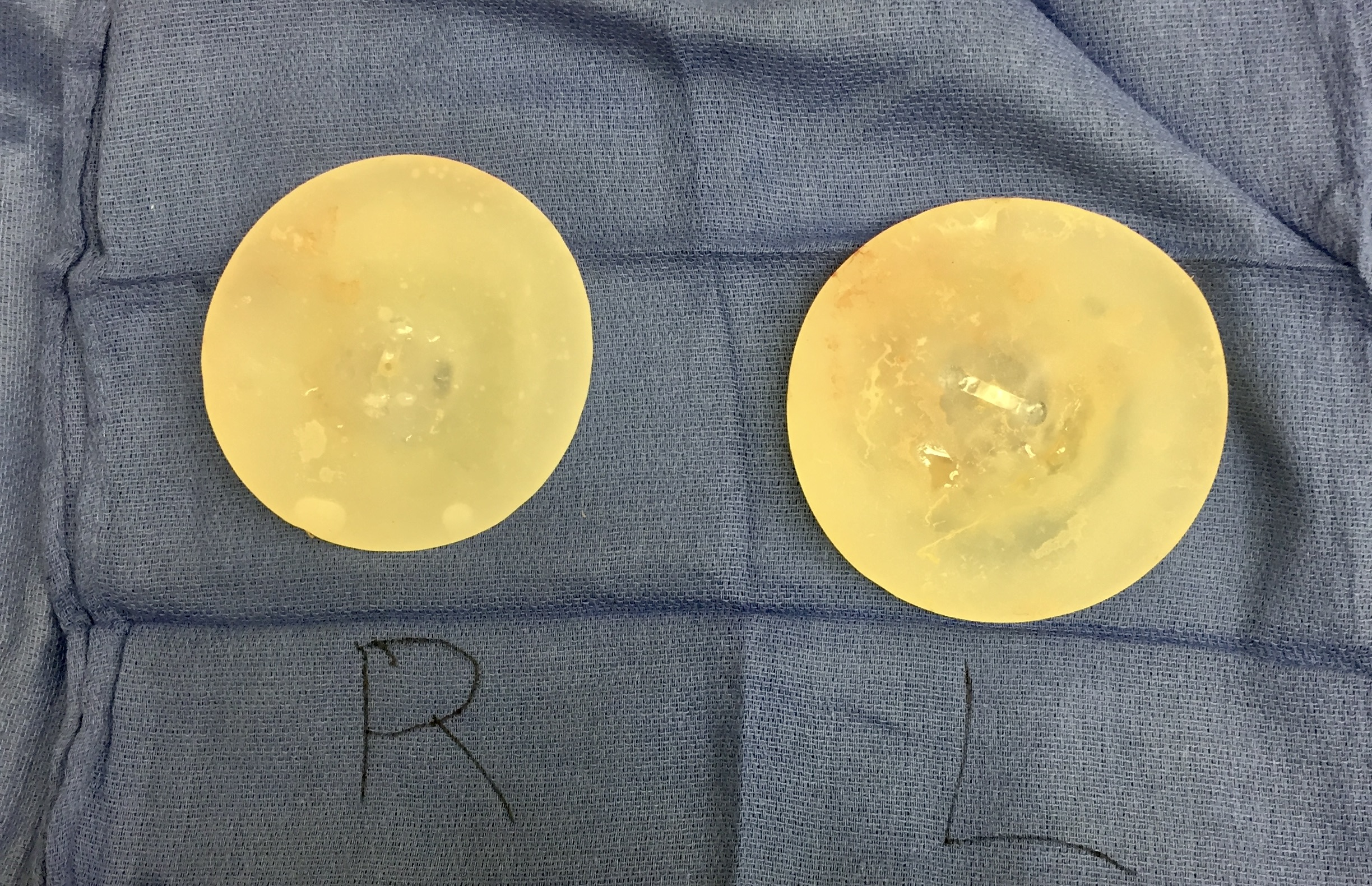 Two round silicone breast implants on a white surface