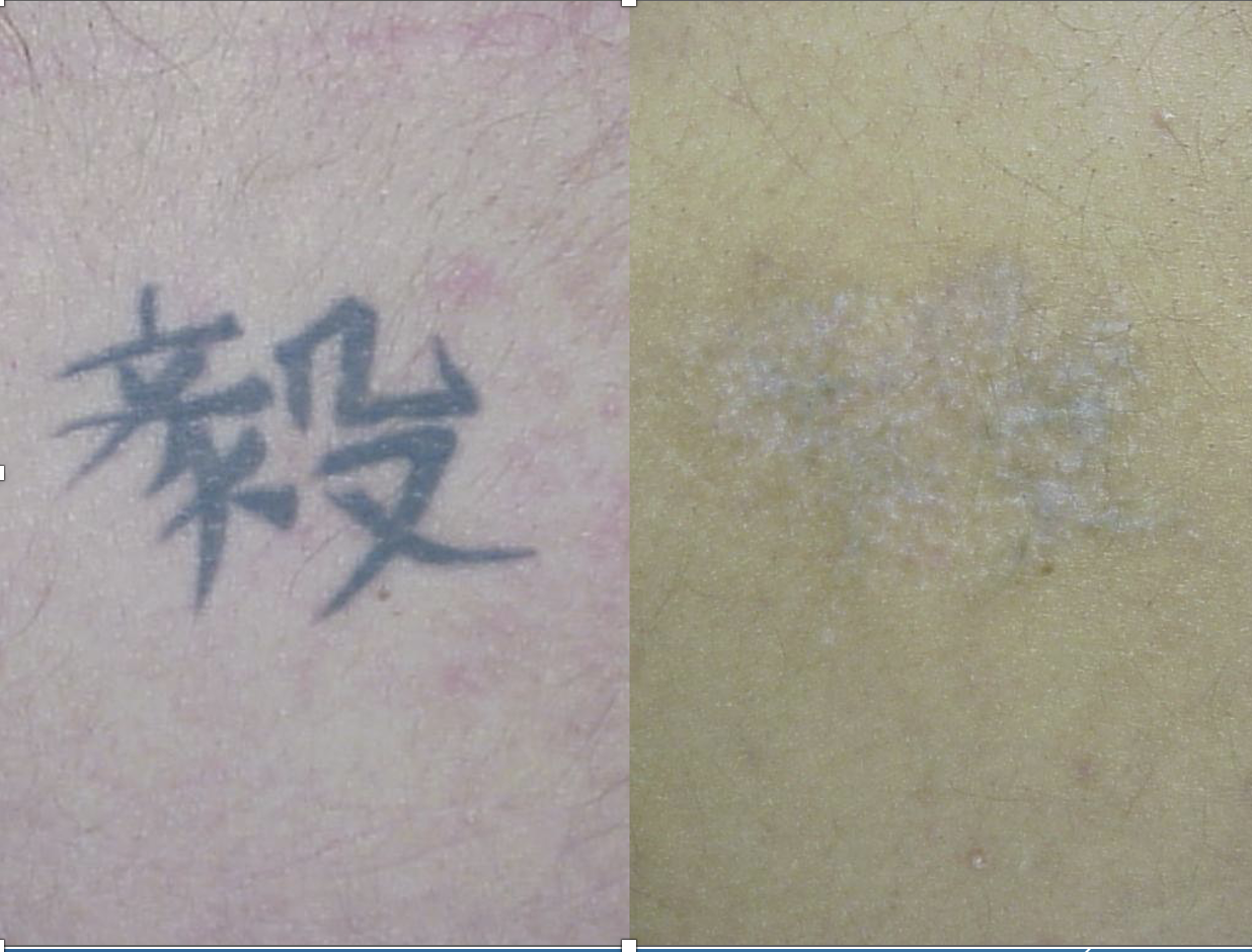 Close-up of a dark ink tattoo on skin before laser removal