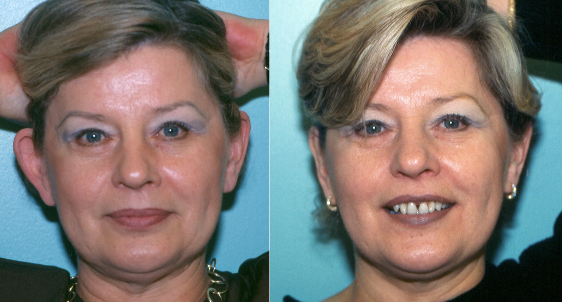 Before and after portraits of a patient following ear reshaping surgery