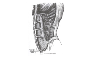 Anatomical illustration of the abdominal wall muscles addressed in a tummy tuck