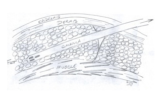 Line illustration of the torso marked with areas treated by liposuction