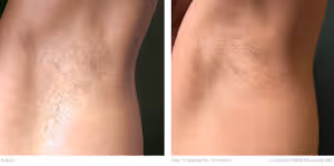 underarm laser hair removal