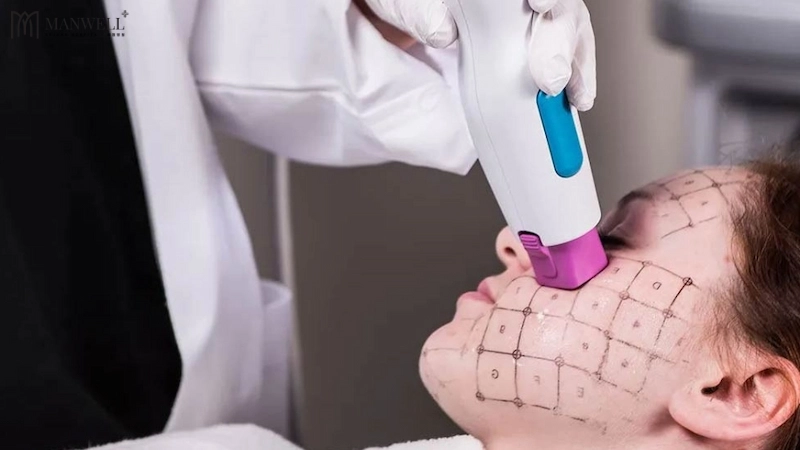 Thermage FLX thường rất an toàn với mọi làn da