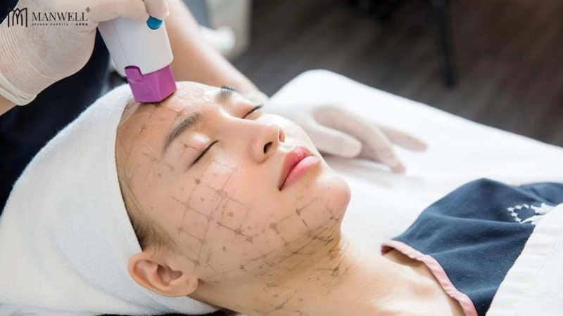 Phương pháp Thermage FLX sử dụng sóng RF để tác động sâu xuống da nhằm cải thiện các vấn đề lão hoá.