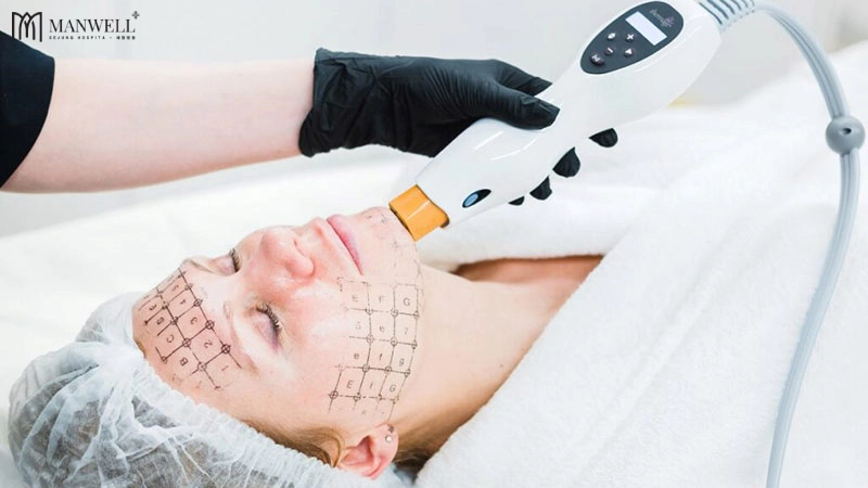 Công nghệ Thermage FLX có khả năng làm săn chắc vùng cổ