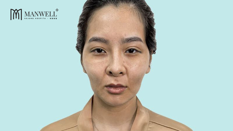 Tình trạng thái dương lõm