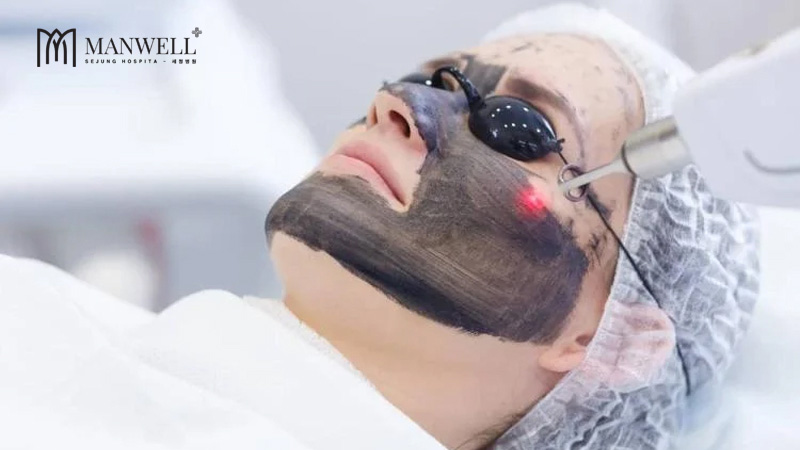 Bắn carbon trẻ hoá da còn có tên gọi khác là laser carbon là công nghệ trẻ hoá da