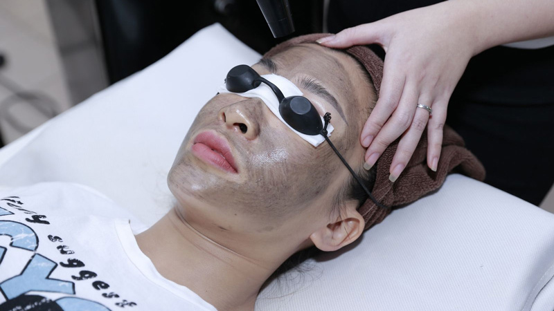 Bắn carbon trẻ hoá da có thể gây ngứa ran, châm chích