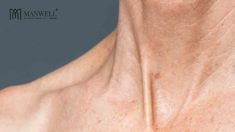 Lão hóa gây nếp nhăn ở cổ 