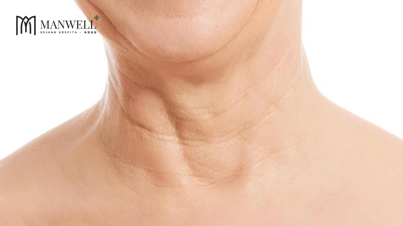 Ánh nắng mặt trời cũng là tác nhân gây nếp nhăn cổ