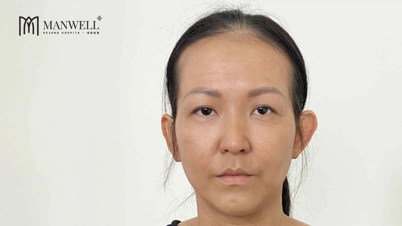 Tình trạng má hóp thái dương lõm