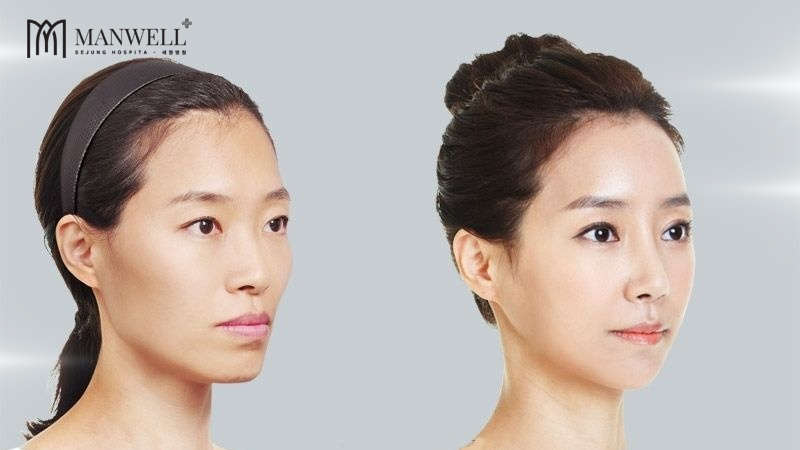 Làm đầy má hóp thái dương lõm bằng cách cấy sợi Collagen