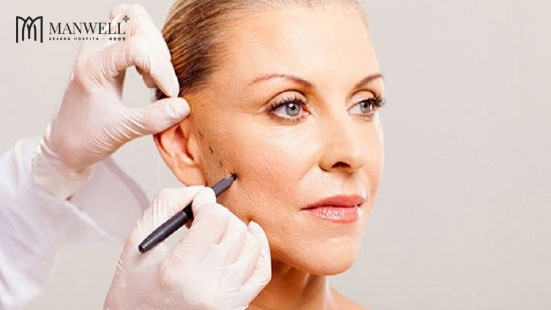 Quy trình căng da mặt bằng chỉ sinh học