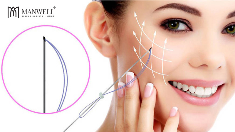 Căng chỉ collagen