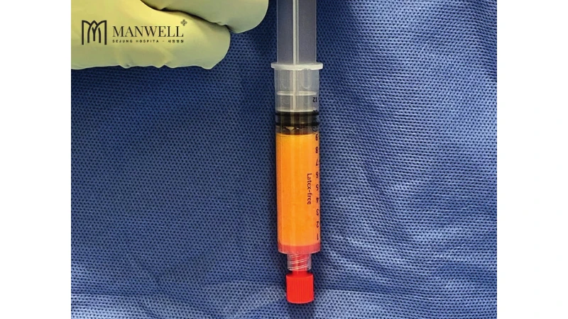 Phần mỡ được lấy ra từ vùng bụng, bắp tay, bắp đùi được cấy lại vào vùng má hóp