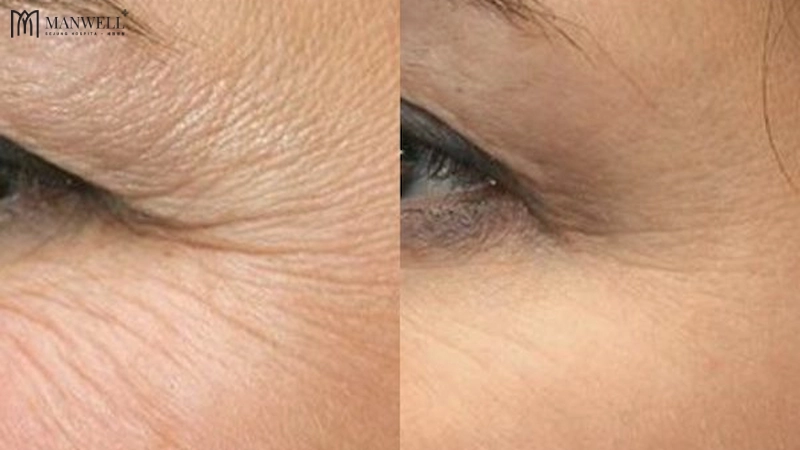 Các nếp nhăn, vết chân chim mờ đi rõ rệt sau tiêm botox