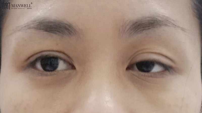 Nếu không được tiêm botox đúng kỹ thuật, mắt có thể bị sụp mí