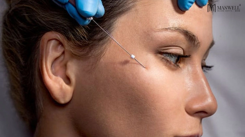 Căng chỉ mắt là kỹ thuật dùng kim luồn chỉ sinh học tự tiêu vào trong vùng da mắt, kéo căng giúp xoá nhăn và nâng cơ vùng mắt