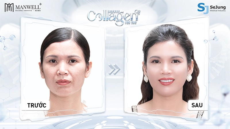 Khách hàng Mya Trần trước và sau khi trẻ hoá da toàn diện bằng liệu pháp Manwell Collagen FDA 360
