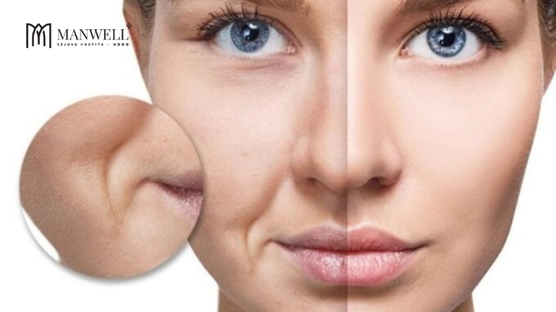 Rãnh cười sâu là thủ phạm khiến gương mặt già hơn tuổi