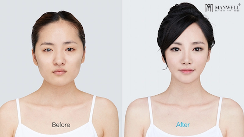 Combo hạ gò má gọt hàm giúp đường nét trên gương mặt thanh thoát, V-line.