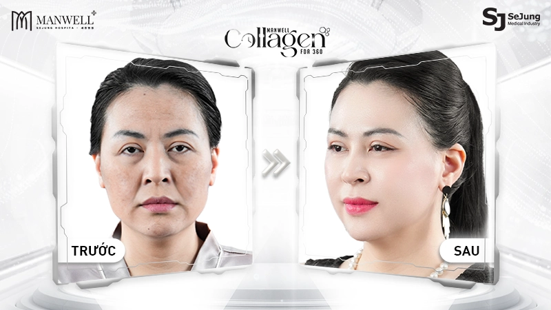 Liệu pháp Manwell Collagen FDA 360 giúp trẻ hoá gương mặt toàn diện, từ đó khuôn mặt trở nển đầy đặt, mềm mại hơn, gò má không còn cao và đường viền hàm cũng thanh thoát hơn.