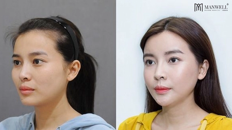 Không phải ai cũng có thể thực hiện combo này, nên tuân theo khuyến cáo hoặc nghe tư vấn của bác sĩ.