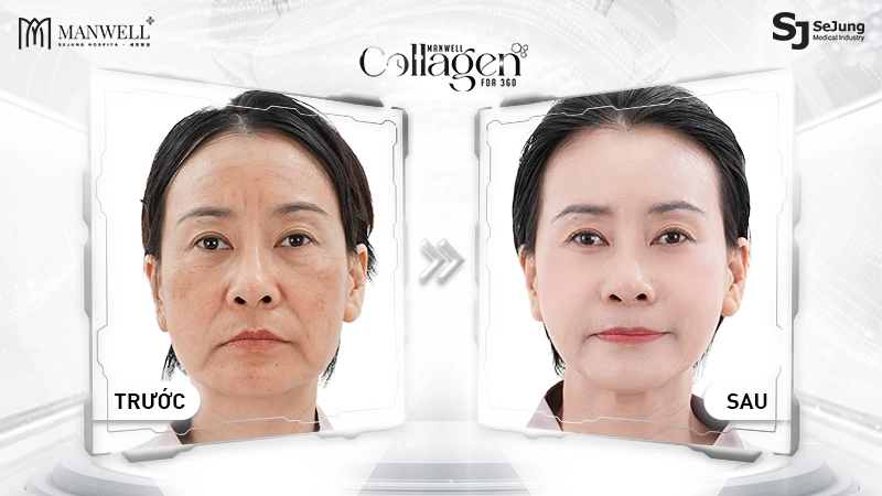 Liệu pháp Manwell Collagen FDA 360 không chỉ giúp hạ gò má mà còn ter hoá toàn diện gương mặt tối ưu