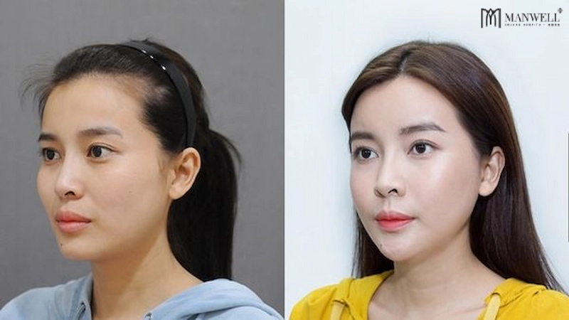 Hạ gò má giúp các đường nét trên gương mặt trở nên mềm mại hơn