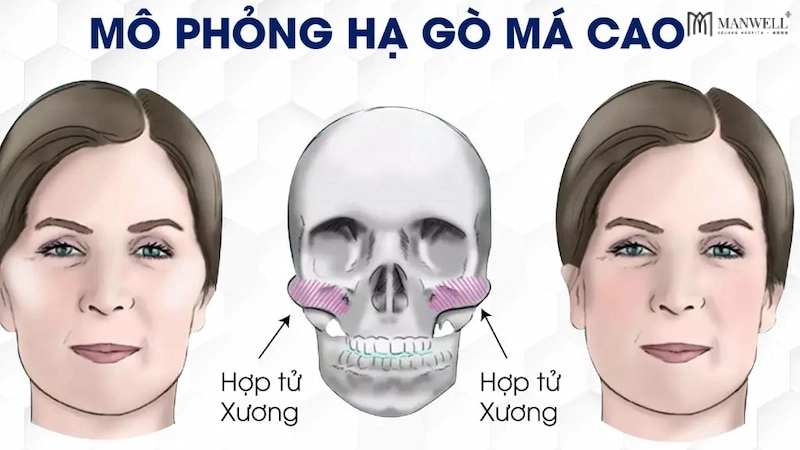 Phẫu thuật hạ gò má giúp hạ triệt để phần thân và cung tiếp của xương gò má