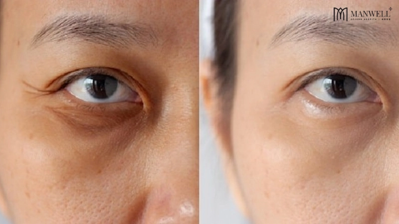 Giảm bọng mắt, thâm quầng, làm săn chắc vùng da mắt