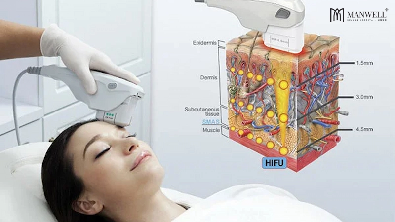 Nguyên lý trẻ hoá da của công nghệ HIFU