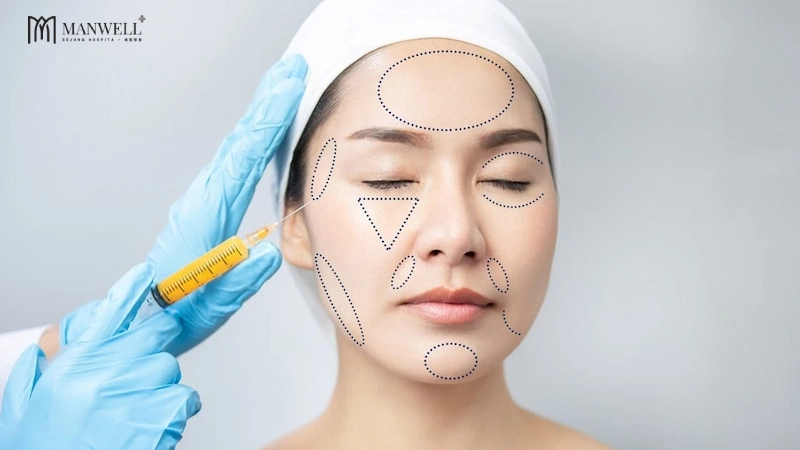 Cấy mỡ tự thân giúp làm đầy thể tích vùng thái dương