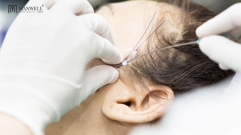 Căng chỉ sinh học sẽ kéo căng vùng da bị lõm, cải thiện thái dương hóp