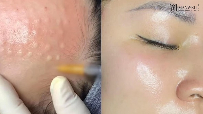 Các dưỡng chất khi được tiêm vào sẽ giúp làn da căng mọng, bóng mịn