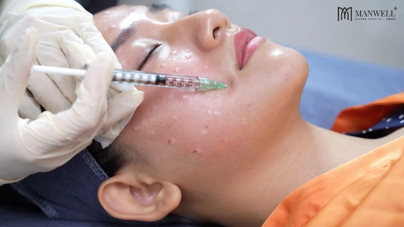 Tuỳ vào tình trạng da, các mũi tiêm sẽ tiêm sâu 1 - 4mm vào da.