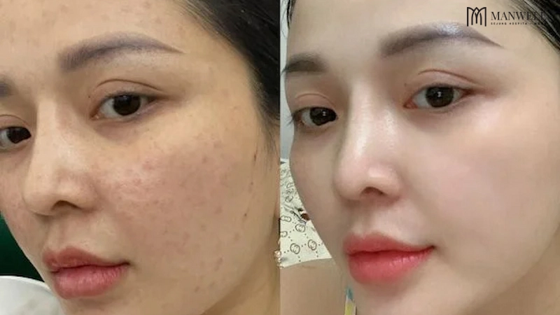 Mesotherapy cung cấp các dưỡng chất kích thích tăng sinh collagen tự nhiên, giúp cải thiện độ săn chắc và căng bóng của da
