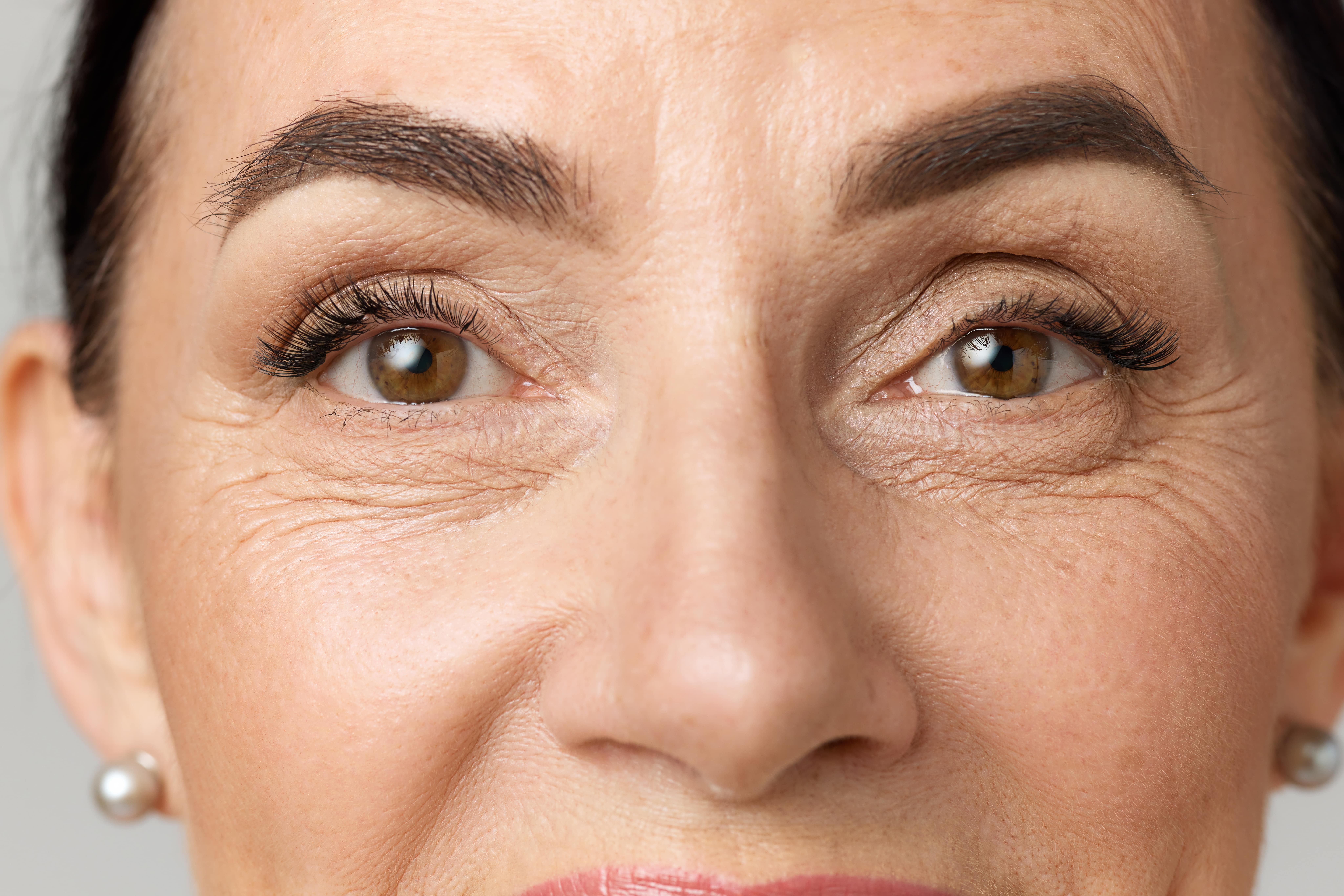 Top Benefits of Botox Beyond Wrinkle Reduction